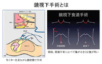 鏡視下手術とは