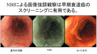 NBIによる画像強調観察は早期食道癌のスクリーニングに有用である