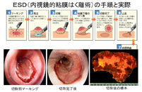 ESD（内視鏡的粘膜はく離術）の手順と実際